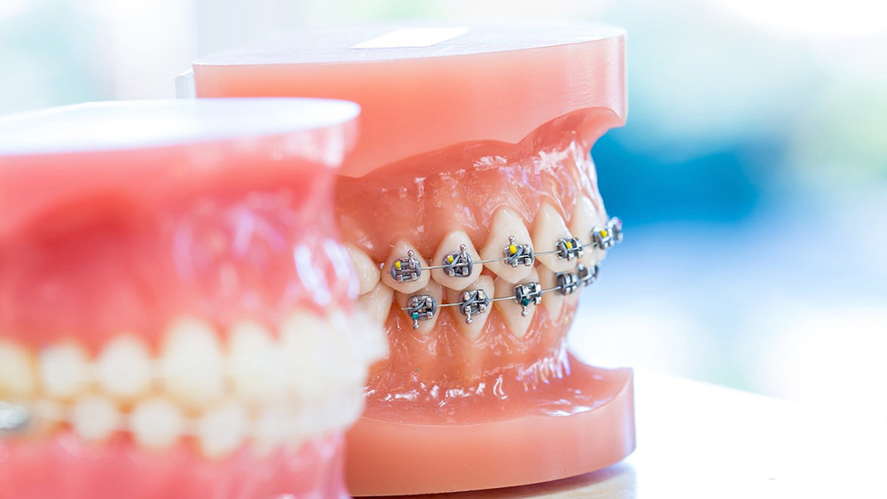 Diş Teli Tedavisi Hakkında Bilinmesi Gerekenler, Merak Edilenler