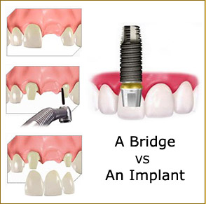 implant köprü karşılaştırması