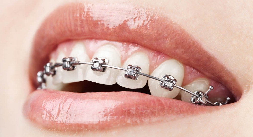 Klasik Metal Braketler İle Ortodontik  Tedavi