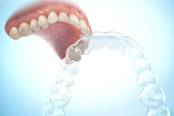 Şeffaf Plaklarla Ortodontik Tedavi