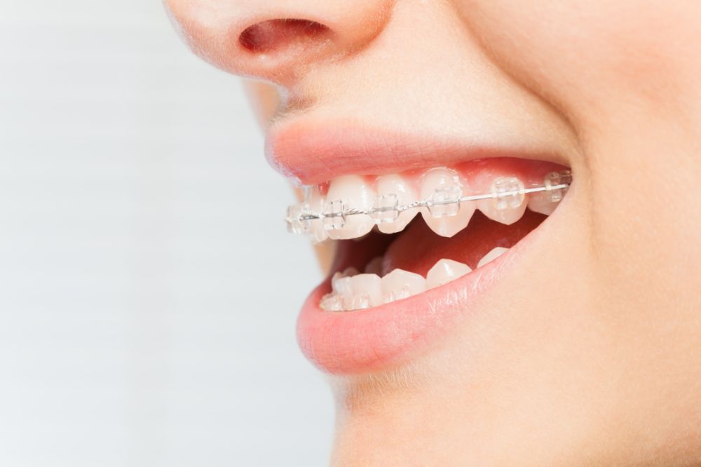 Seramik Braketler İle Ortodontik Tedavi